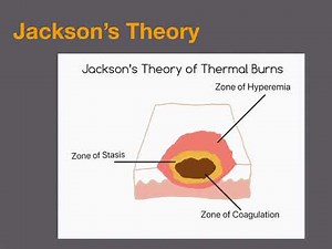 Thermal Burns for EMS