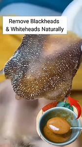 Remove Blackheads and Whiteheads instantly At Home . . . #blackheads #whiteheads #blackheadsremoval #whiteheadsremoval #skincare #reelsvideoシ #fbreelsfypシ゚ #reelsviralシ #fbreelsfypシ゚viralシ #reelschallenge #explorepage | Natural Beauty Recipes