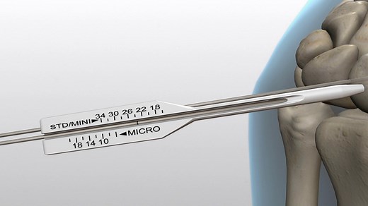Acutrak 2® Scaphoid Fracture Surgical Technique Animation