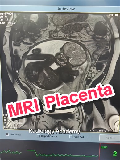 MRI Placenta ☢️❤ #Radiologyacademy #mri #radiology #ctscan #hospital