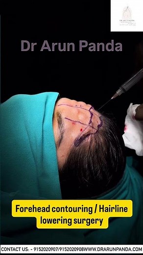 Forehead Contouring & Hairline Lowering Surgery | Facial Feminization by Dr Arun Panda