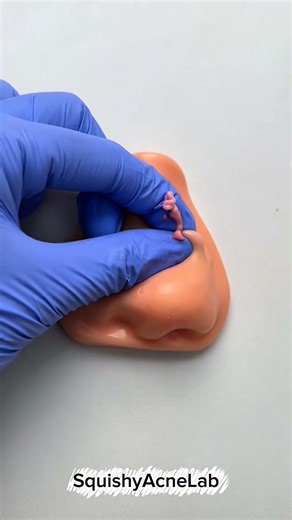 Nose full of pimples #shorts #viral #asmr #viralshorts #shortvideo #SquishyAcneLab1