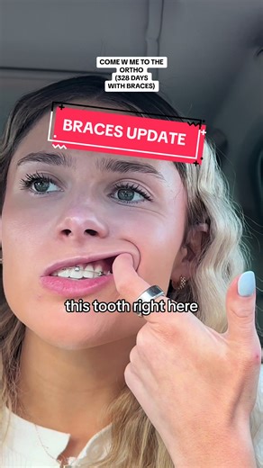 Last Ortho Appointment Before Braces Off | Implant Tooth & Rubber Bands