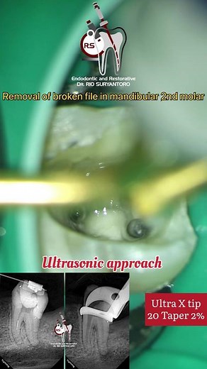 Removal of Broken Endodontic File: Step-by-Step Protocols