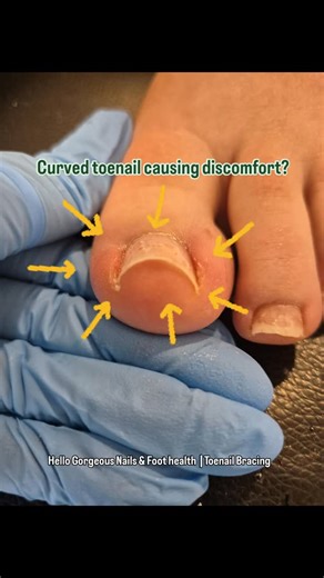 A curved toenail can feel uncomfortable and become more painful over time. This client experienced instant visible improvement the moment the brace was applied and relief almost immediately. 💫 Toenail bracing is a gentle, non-invasive treatment that helps guide the nail into a healthier, straighter shape over the coming weeks. If your nails curve, pinch, or cause discomfort, this may be the perfect solution for you. DM me BRACE for advice or to book your consultation. 🦶 . . . . . #ToenailBraci