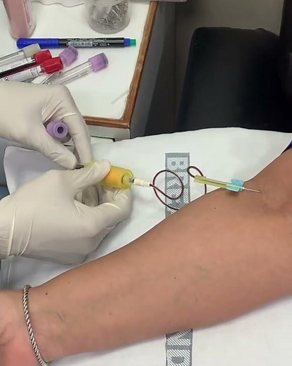 Blood collection through butterfly or scalp vein set