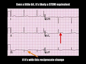 EMCrit 146 - Who Needs an Acute PCI with Steve Smith (Part I)