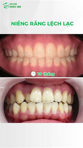 Răng lệch lạc trở nên hài hòa hơn sau 19 tháng #nhakhoa #niengrang #shorts