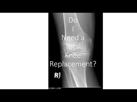 How To Know If You Need A Knee Replacement