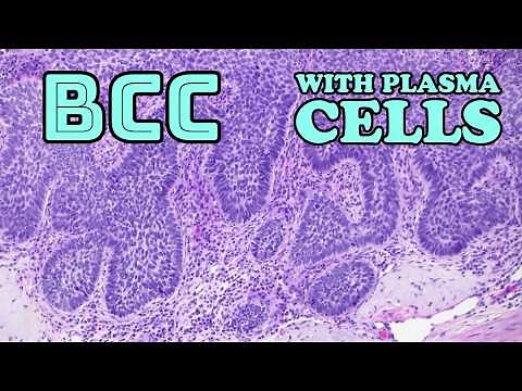 Basal cell carcinoma under microscope (BCC with TONS of plasma cells!) skin cancer pathology