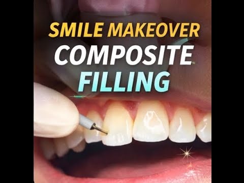Composite Restoration of Front Tooth Natural Smile Makeover