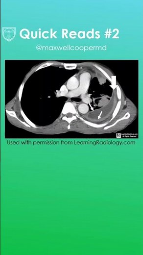 Empyema on CT Explained