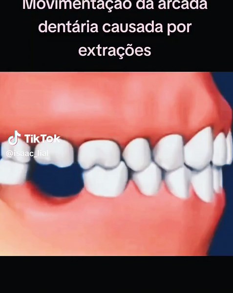 Movimentação dos Dentes: Causas e Consequências