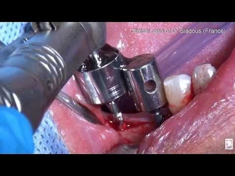 MD Guide WAM: Dental Implant Pilot Guide Drill - Golden Dental Solutions