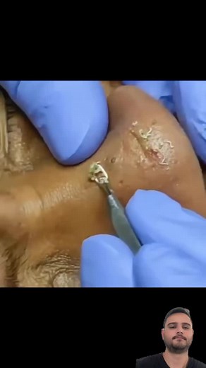 Effective Blackhead Removal Techniques You Need to Know