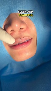 #drpu #lipsurgery #thailand #correction #lip A cleft lip revision case: The patient, who has had a cleft lip and palate since childhood, traveled from Indonesia to undergo corrective upper lip surgery with Dr. Pu in Thailand. The main issues were excess tissue drooping on the sides and an unbalanced lip shape. After surgery, the improvement is clearly visible. When it comes to lip surgery, choose the best hands. ⸻ 唇裂修复案例：这位患者从小患有唇腭裂，特地从印度尼西亚前往泰国，找Dr. Pu进行上唇修复手术。 主要问题是两侧组织下垂及唇形不对称。 术后效果显著，变化清晰可见。