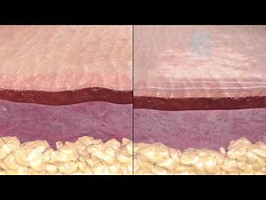 Kelo-cote: How It Works