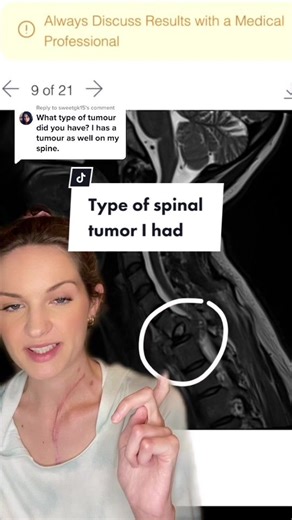 Understanding the Spinal Tumor: Types and Treatments