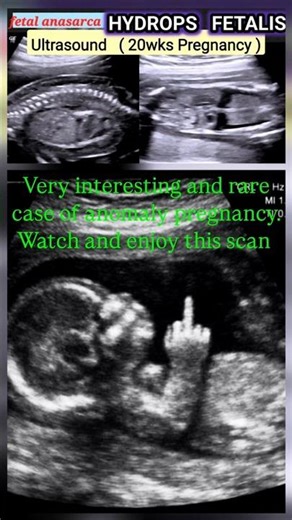 fetal anasarca with hydrops fetalis anomaly pregnancy case. watch and enjoy this scan.