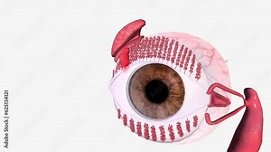 A chalazion is a slowly developing lump that forms due to blockage and swelling of an oil gland in the eyelid