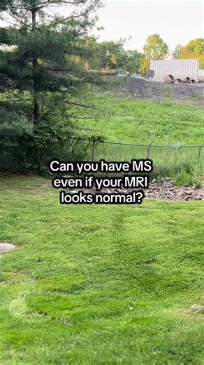 Can You Have MS If Your MRI Looks Normal?
