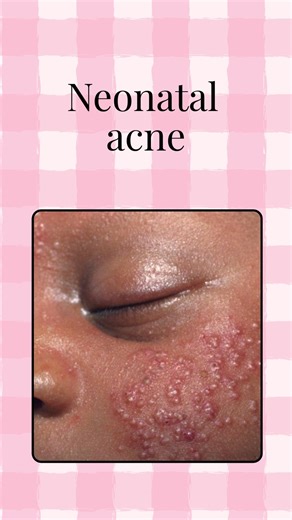 Shivani Bansal on Instagram: "Neonatal Acne: Totally Normal, Totally Temporary Tiny bumps on your newborn’s skin can look worrying, but neonatal acne is harmless and usually clears on its own. No treatments, no creams — just gentle care and patience. 🤍 #NeonatalAcne #NewbornSkin #BabySkincare #NewbornCare #PediatricTips #GentleParenting #BabyHealth #MomLife #DadLife #Parenting101 #NewbornFacts"