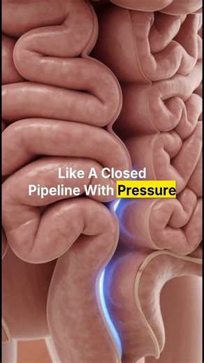 Constipation – Hormones, Pain & Stress Effects (3D Animation))