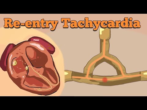 Reentry Tachycardia | AVNRT, AVRT (including WPW-syndrome)