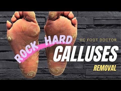 Rock Hard Calluses: Removal of Multiple Stubborn Hard Calluses (Pre-COVID)