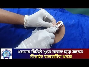 ডিভাইস কসমেটিক সুন্নতে খাৎনা | মুসলমানি | Alisklamp Device Circumcision | Khotna | Mosolmani