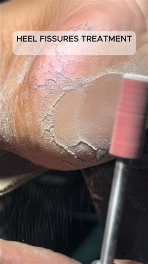 Extreme Heel Fissures Treatment