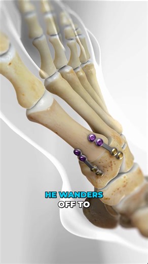 Grandpa’s bunion? Time for a reboot. Lapiplasty® 3D Bunion Correction doesn’t just shave the bump — it realigns the bone at the root of the problem. ⚙️ Plates and screws lock it solid so the bunion can’t creep back. 👉 Join Viz Medical for early access custom emojis: https://loom.ly/QMu5vTs #Lapiplasty #BunionSurgery #FootHealth #3DMedicalAnimation #MedicalAnimation #SurgicalAnimation | Viz Medical