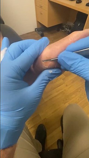 Ultimate Deep Pinch Callus Removal Transformation by Expert Podiatrist #FootCare #Podiatry