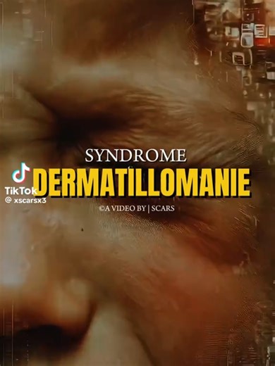 Le syndrome de dermatillomanie @scarsx3🪴🍀 #psychologie