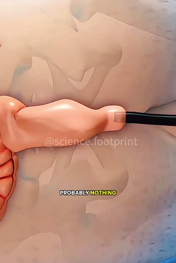 How Polypectomy Is Done (3D Animation) #medical3danimation #3dmedicalanimation #polypectomy #polypremoval #endoscopy