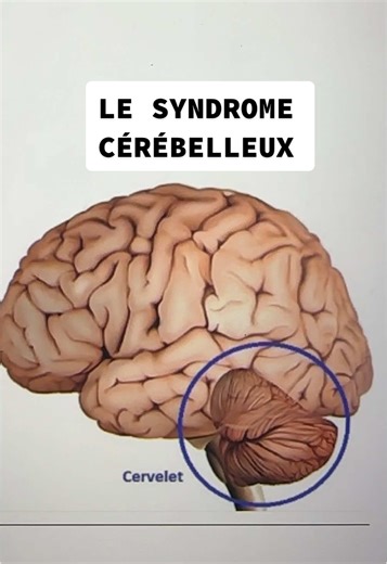 Comprendre le syndrome cérébelleux en 2 minutes