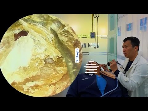 Deep Ear Cleaning Procedure — Insanely Satisfying Ear Wax Removal