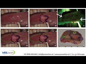 VELscope Guided Surgery - Advanced Oral Cancer Treatment: Case Report 2