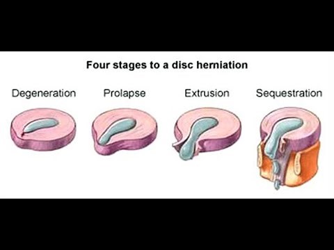 Physiotherapy for Intervertebral Disc prolapse! #StayHome and study #WithMe