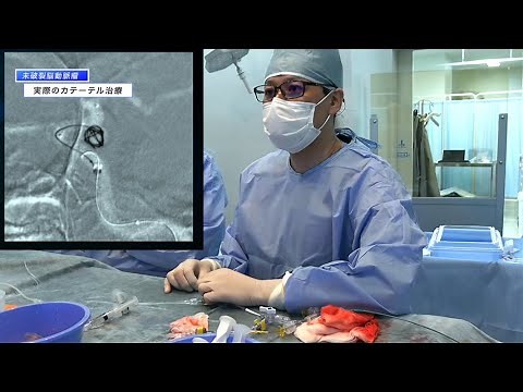 未破裂脳動脈瘤