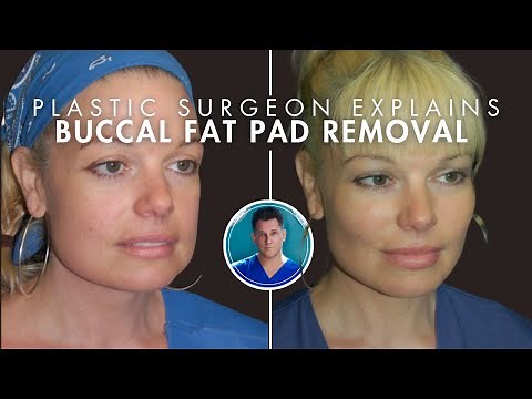 BUCCAL FAT PAD REMOVAL: Surgery, Recovery, Before and After
