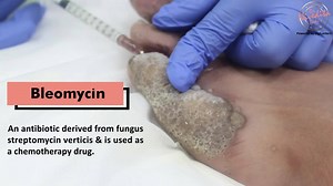 In Dermatology, Intralesional bleomycin injection is used to treat viral warts where other modalities might not work very well. Watch the video for further details. . . . #Intralesionalbleomycin #bleomycin #viralwarts #wartsremoval #wartstreatment #plantarwarts #skinspecialistindelhi #lovefordermatology #drniveditadadu | Dr. Nivedita Dadu's Dermatology Clinic