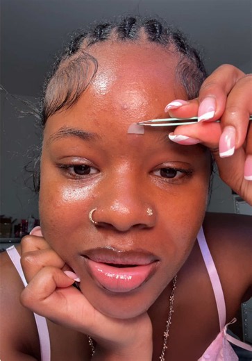 Acne Extraction Compilation: 4 Times in One Visit (Satisfying)