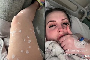 I filmed as killer infection ravaged my body starting as 'harmless' spots