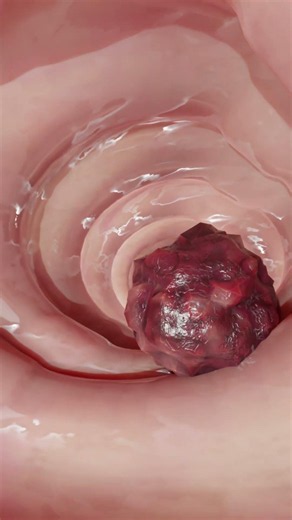 मरीज की जान खतरे में थी! ऐसे निकाला गया Removing Blood Clot Doctor' Shocking Discovery and Procedure