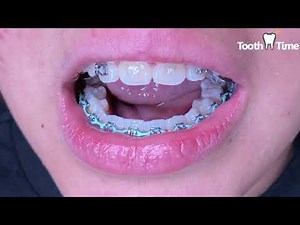 Braces off - What happens when you get your braces off - Tooth Time Family Dentistry