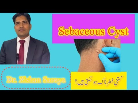 Sebaceous Cyst, causes and Treatment