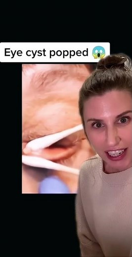 Eyelid Cyst Pop! Cyst of Zeis or Meibomian Cyst?!
