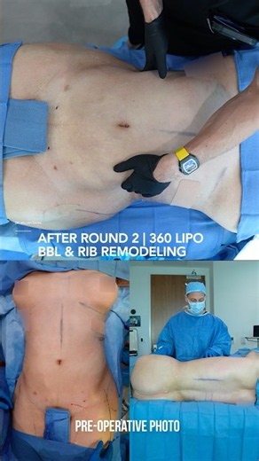 360 lips & BBL with Rib Remodeling #ribremodeling #genderaffirmingsurgery #liposuction #bbl #lipo