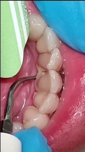 Watch this satisfying teeth scaling in action #tartarremoval #dentalhygiene